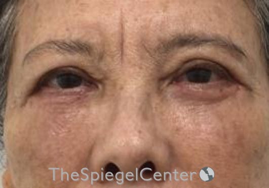 Blepharoplasty Before & After Gallery - Patient 165782 - Image 2