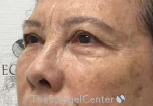 Blepharoplasty Before & After Gallery - Patient 165782 - Image 3