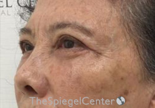 Blepharoplasty Before & After Gallery - Patient 165782 - Image 4