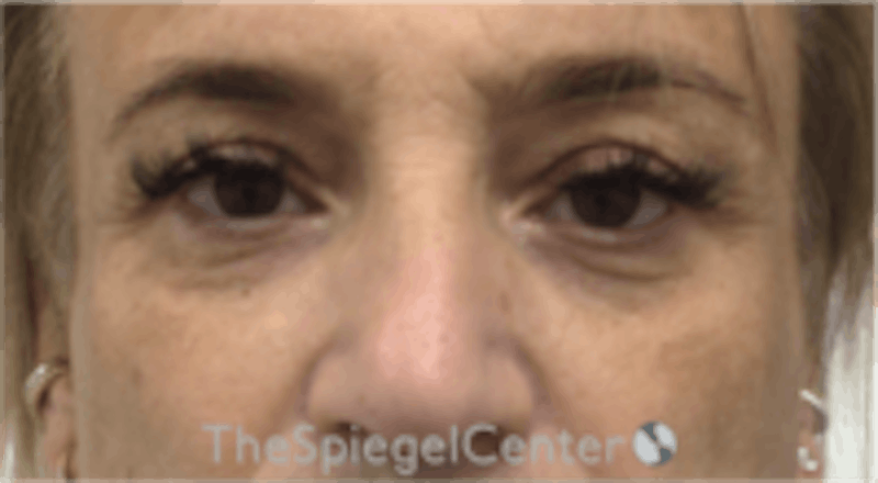 Blepharoplasty Before & After Gallery - Patient 241854 - Image 1