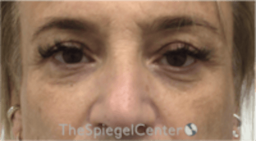 Blepharoplasty Before & After Gallery - Patient 241854 - Image 1