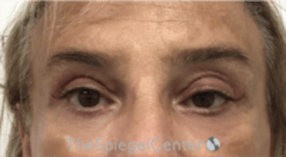 Blepharoplasty Before & After Gallery - Patient 241854 - Image 2
