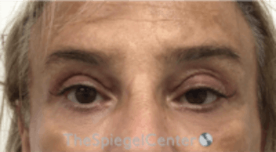 Blepharoplasty Before & After Gallery - Patient 241854 - Image 2