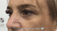 Blepharoplasty Before & After Gallery - Patient 241854 - Image 3