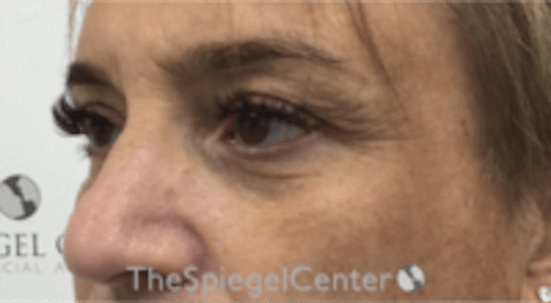 Blepharoplasty Before & After Gallery - Patient 241854 - Image 3