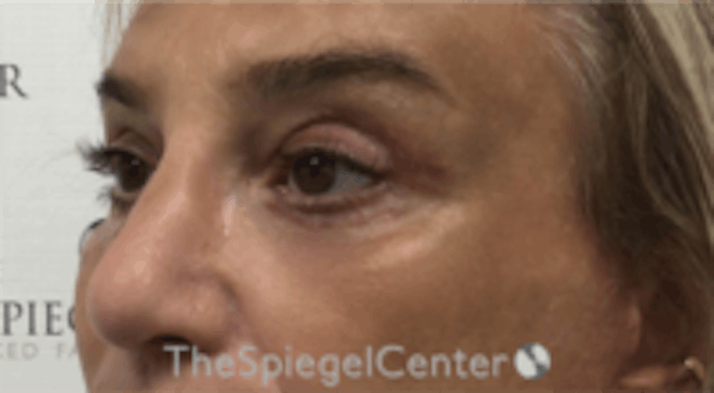 Blepharoplasty Before & After Gallery - Patient 241854 - Image 4