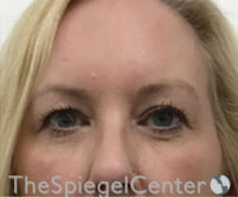Blepharoplasty Before & After Gallery - Patient 418833 - Image 1
