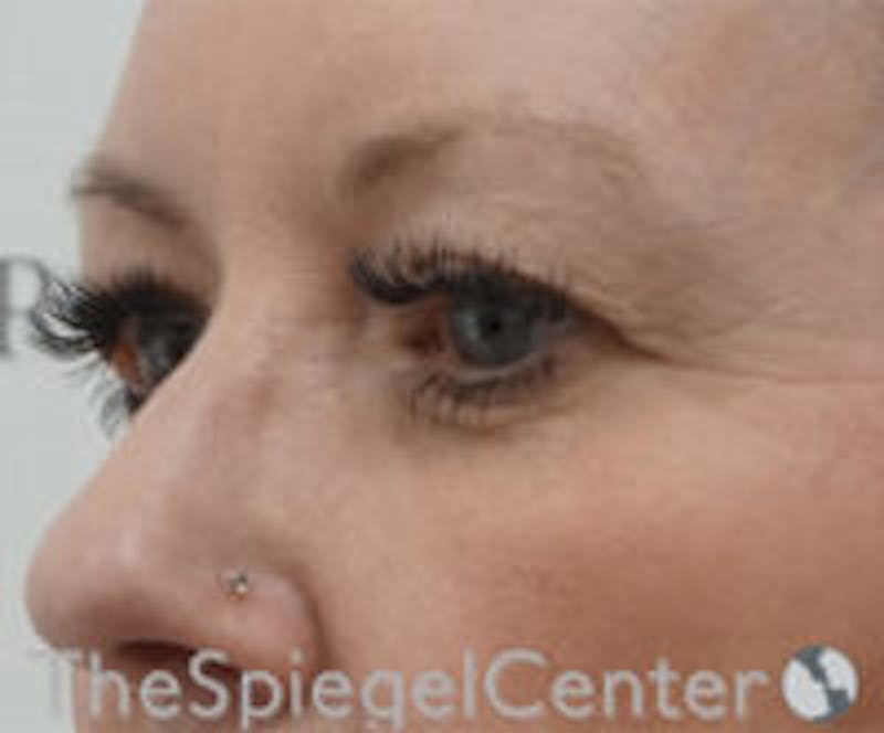 Blepharoplasty Before & After Gallery - Patient 418833 - Image 3