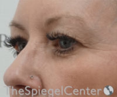 Blepharoplasty Before & After Gallery - Patient 418833 - Image 3