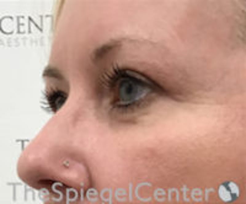 Blepharoplasty Before & After Gallery - Patient 418833 - Image 4