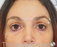 Blepharoplasty Before & After Gallery - Patient 238567 - Image 2