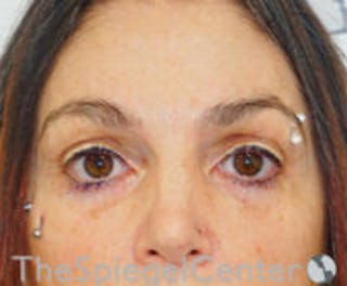 Blepharoplasty Before & After Gallery - Patient 238567 - Image 2