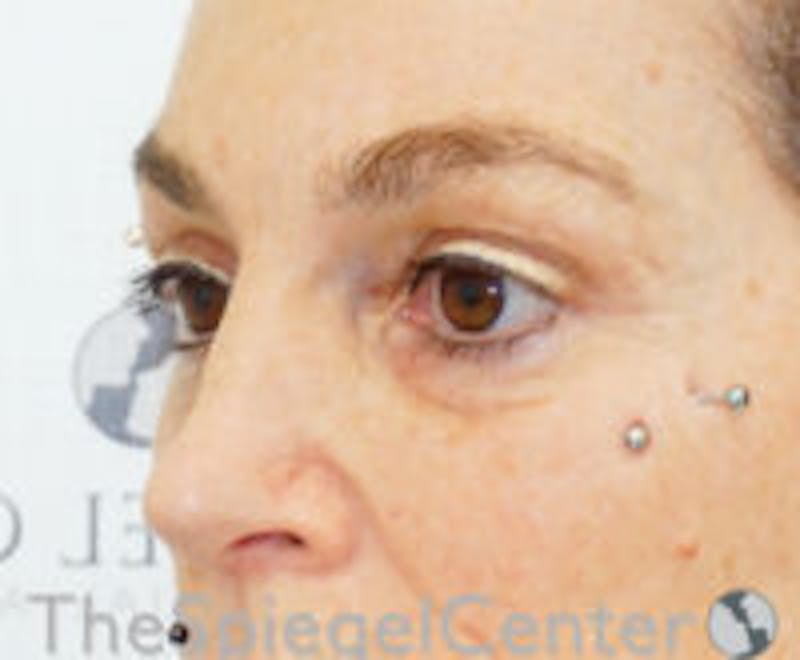 Blepharoplasty Before & After Gallery - Patient 238567 - Image 3