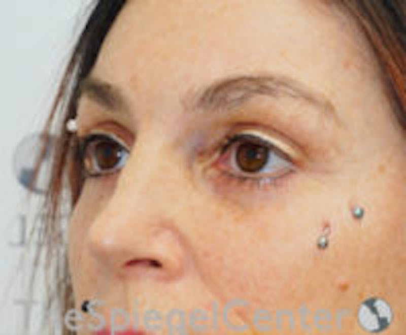 Blepharoplasty Before & After Gallery - Patient 238567 - Image 4