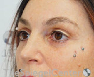 Blepharoplasty Before & After Gallery - Patient 238567 - Image 4
