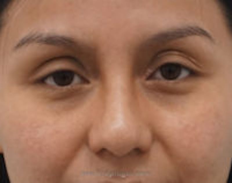 Blepharoplasty Before & After Gallery - Patient 370314 - Image 2