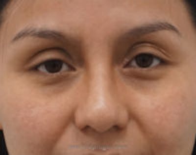 Blepharoplasty Before & After Gallery - Patient 370314 - Image 2