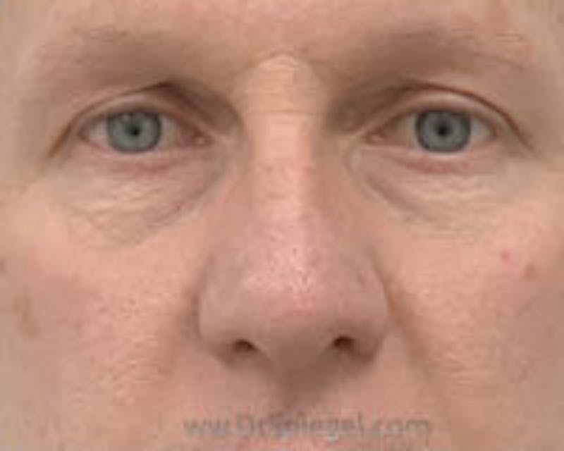 Blepharoplasty Before & After Gallery - Patient 292983 - Image 1