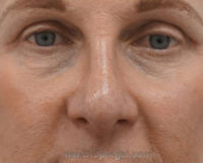 Blepharoplasty Before & After Gallery - Patient 292983 - Image 2