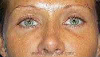 Blepharoplasty Before & After Gallery - Patient 387698 - Image 1