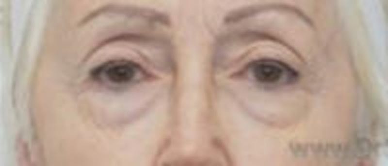 Blepharoplasty Before & After Gallery - Patient 340655 - Image 1