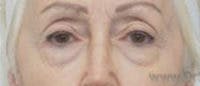 Blepharoplasty Before & After Gallery - Patient 340655 - Image 1