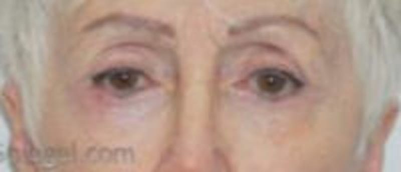 Blepharoplasty Before & After Gallery - Patient 340655 - Image 2