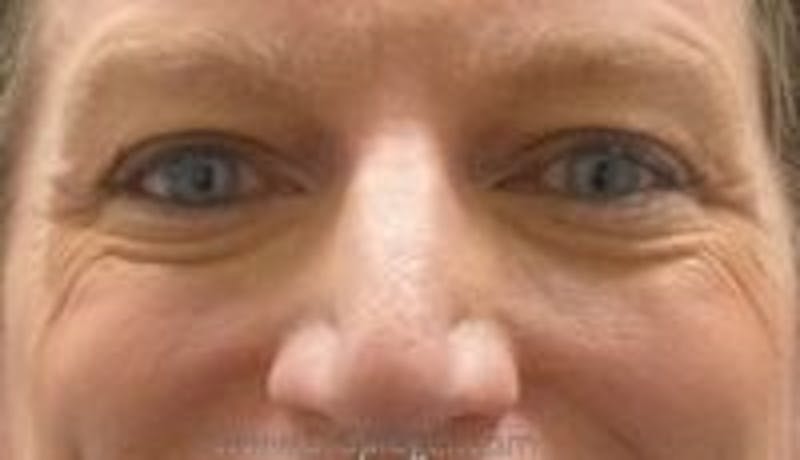Blepharoplasty Before & After Gallery - Patient 324099 - Image 1