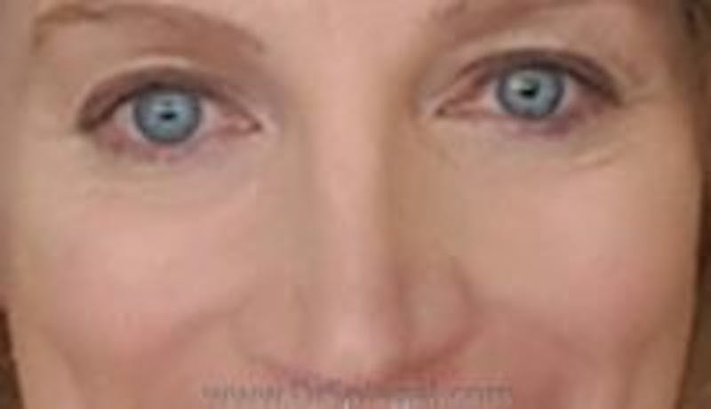 Blepharoplasty Before & After Gallery - Patient 324099 - Image 2