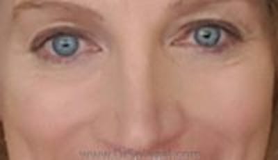 Blepharoplasty Before & After Gallery - Patient 324099 - Image 2