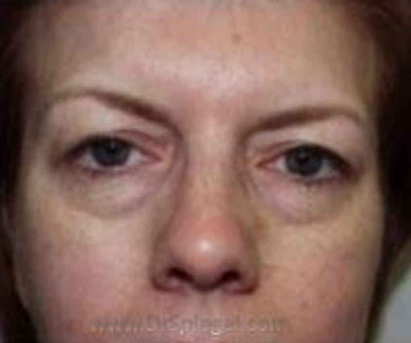Blepharoplasty Before & After Gallery - Patient 257698 - Image 1