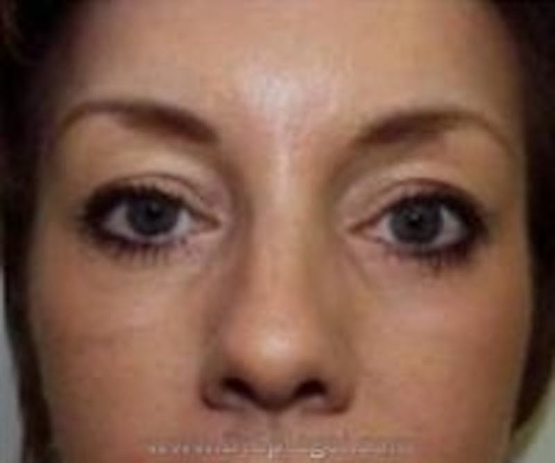 Blepharoplasty Before & After Gallery - Patient 257698 - Image 2