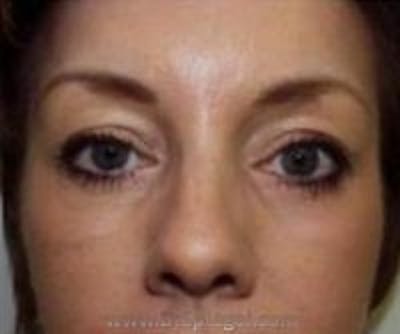 Blepharoplasty Before & After Gallery - Patient 257698 - Image 2