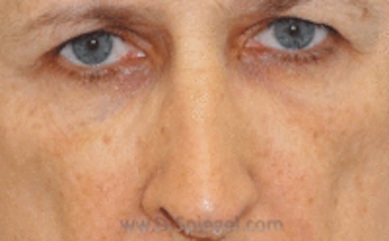 Blepharoplasty Before & After Gallery - Patient 179111 - Image 1