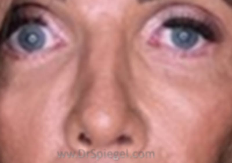 Blepharoplasty Before & After Gallery - Patient 115478 - Image 2