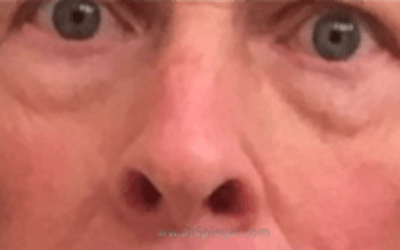 Blepharoplasty Before & After Gallery - Patient 177663 - Image 1