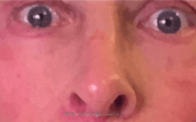 Blepharoplasty Before & After Gallery - Patient 177663 - Image 2