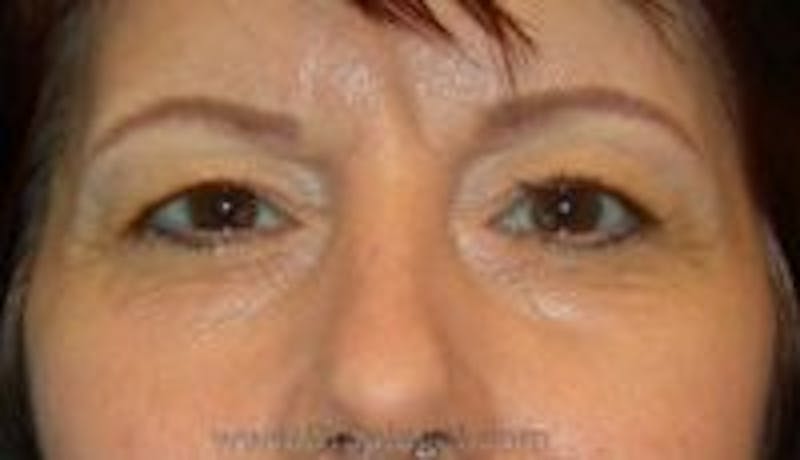 Blepharoplasty Before & After Gallery - Patient 236842 - Image 1