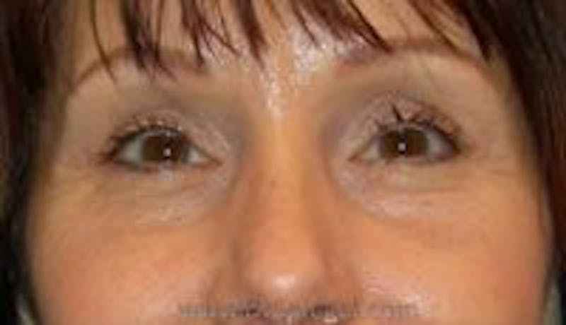Blepharoplasty Before & After Gallery - Patient 236842 - Image 2