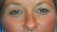 Blepharoplasty Before & After Gallery - Patient 608553 - Image 1