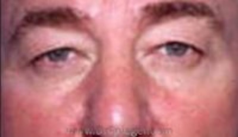 Blepharoplasty Before & After Gallery - Patient 371948 - Image 1