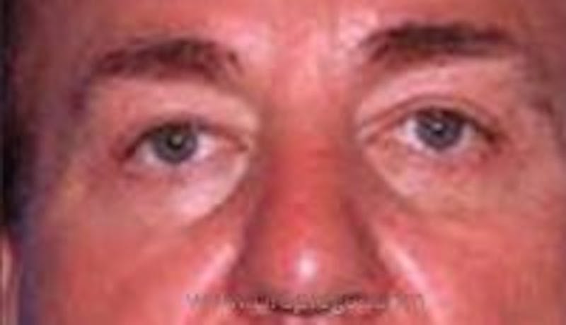 Blepharoplasty Before & After Gallery - Patient 371948 - Image 2