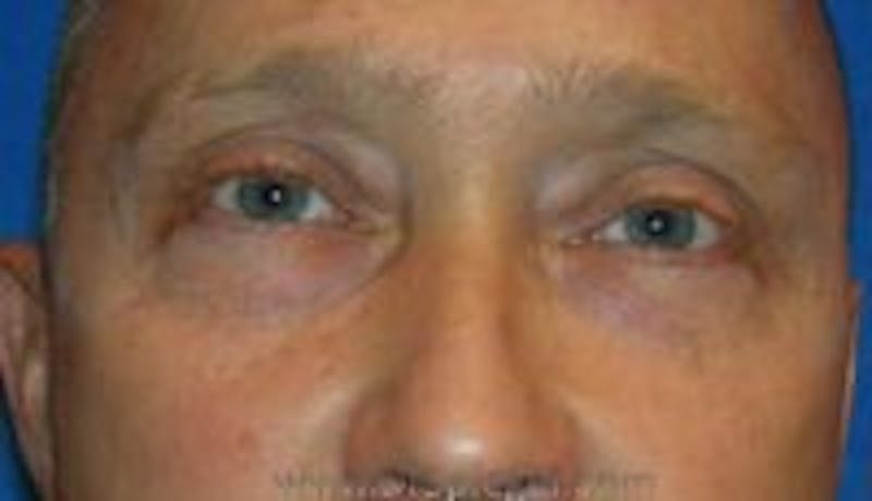 Blepharoplasty Before & After Gallery - Patient 124286 - Image 1