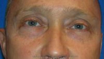 Blepharoplasty Before & After Gallery - Patient 124286 - Image 1