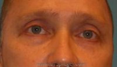 Blepharoplasty Before & After Gallery - Patient 124286 - Image 2