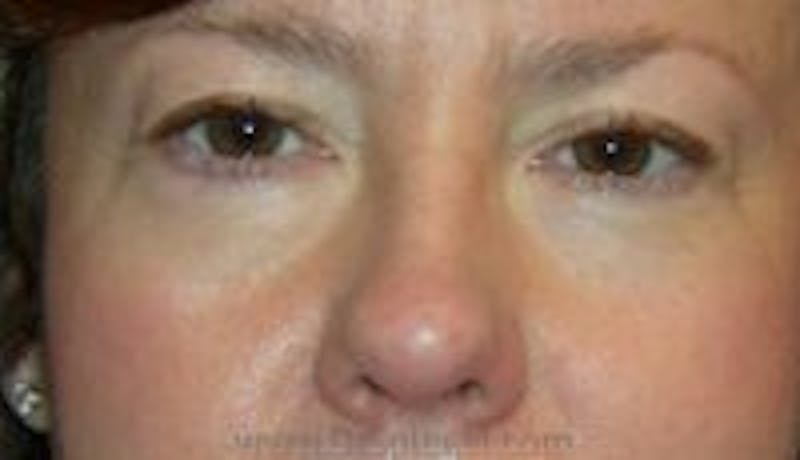 Blepharoplasty Before & After Gallery - Patient 216299 - Image 1