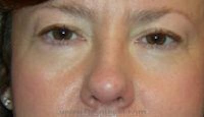 Blepharoplasty Before & After Gallery - Patient 216299 - Image 1