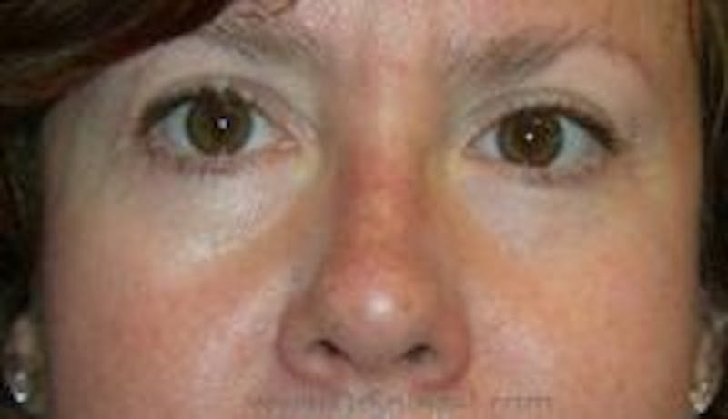 Blepharoplasty Before & After Gallery - Patient 216299 - Image 2