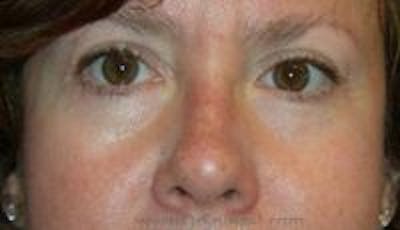 Blepharoplasty Before & After Gallery - Patient 216299 - Image 2
