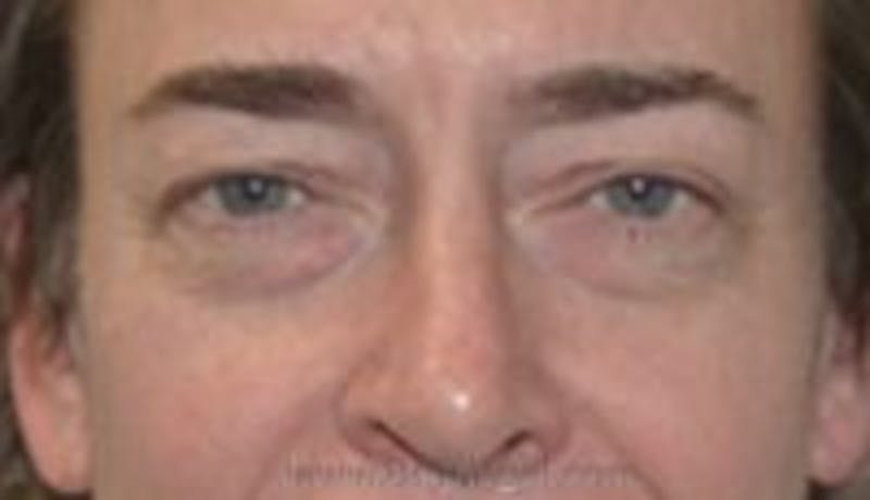 Blepharoplasty Before & After Gallery - Patient 159259 - Image 1